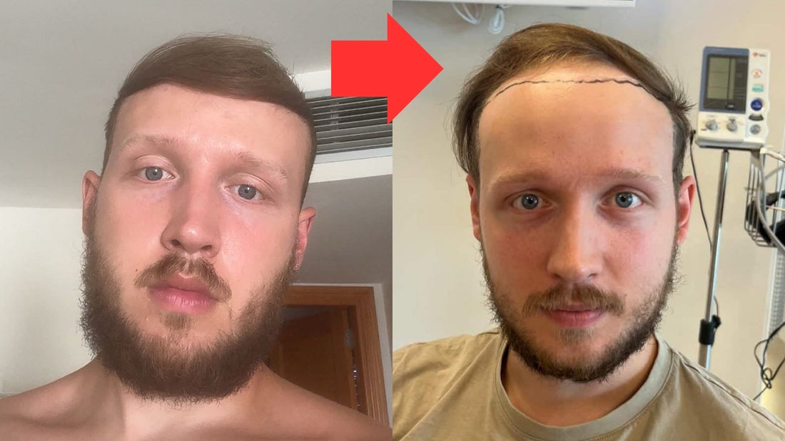 From Hair Fibre Prison To Shaved Head Freedom - Jens' Story